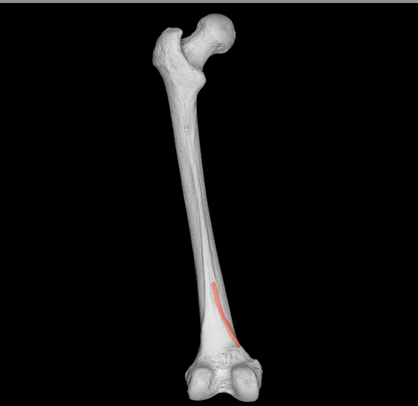 <p>medial side of the split from the linea aspera of femur</p>