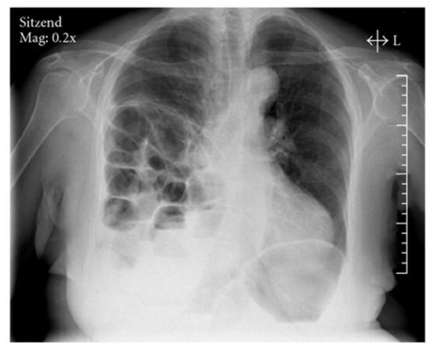 <p>Dx. What is the most common radiologic finding for this dz state?</p>