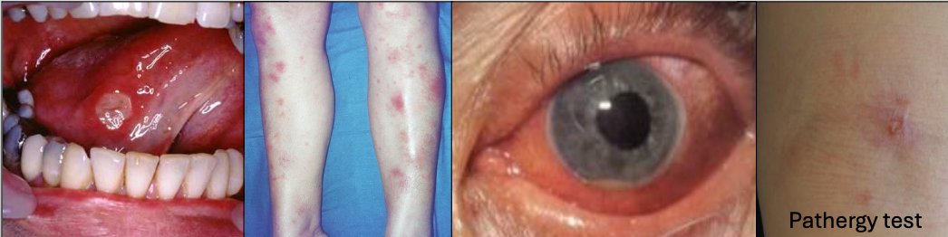 <p>Recurrent oral ulcers 3x/yr + 2 of </p><ol><li><p>Recurrent genital ulcerations (75%)</p></li><li><p>Eye lesions (70%)</p></li><li><p>Skin lesions</p></li><li><p>+ pathergy test (results are variable)</p></li></ol><p></p>