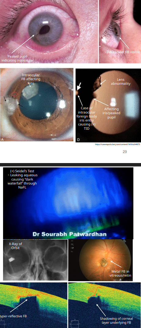 <ol><li><p>look for </p><ol><li><p>pupil irregularities </p></li><li><p>iris tears adn transillumination defect </p></li><li><p>lens abnormalities </p></li></ol></li><li><p>check for </p><ol><li><p><strong><u>+ Seidel Test </u></strong>= dark waterfall effect of NaFl being washed away</p><ol><li><p>aq is coming out </p></li></ol></li><li><p><strong><u>DFE to see if it made it to vitreous or retina</u></strong></p></li><li><p><strong><u>OCT shows depth of FB</u></strong></p></li><li><p><strong><u>ORBITAL XRAY</u></strong></p></li></ol></li></ol><p></p>