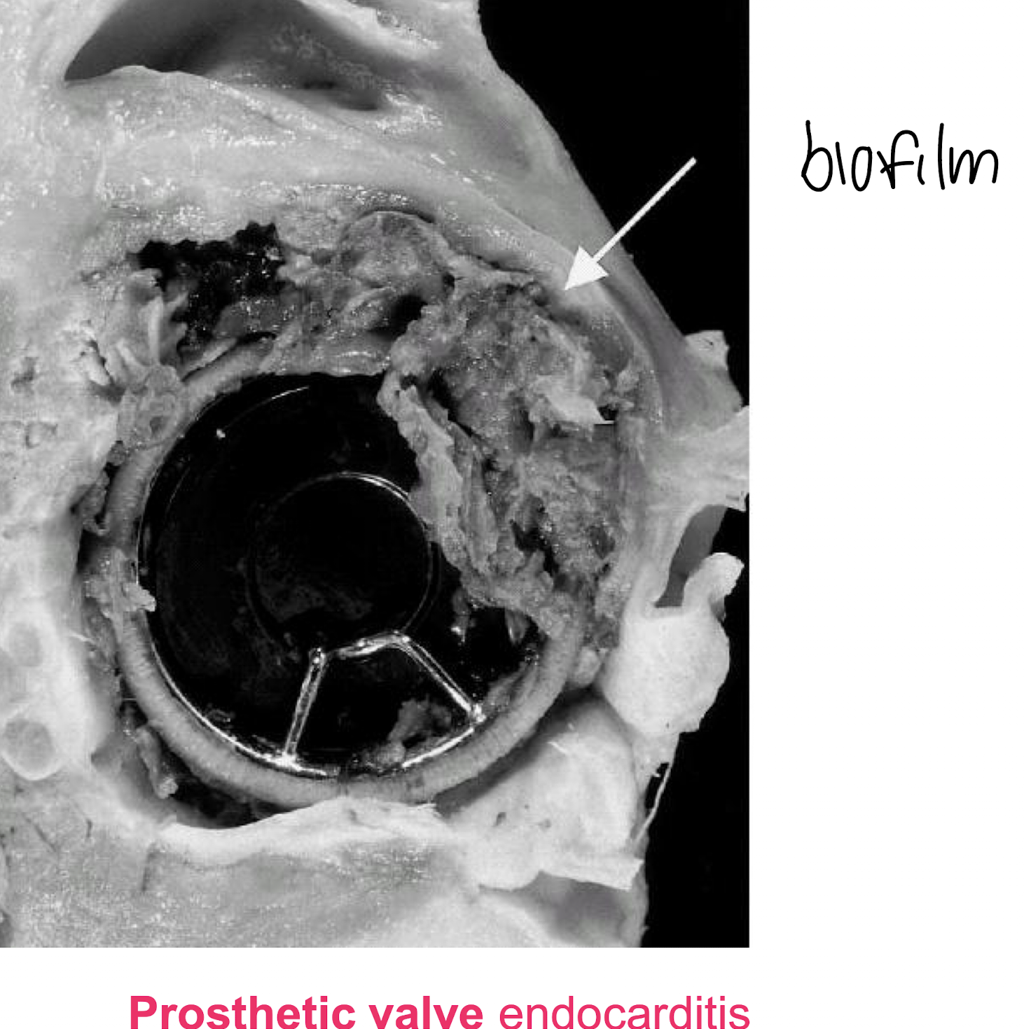 <p><strong><u>Foreign body infections</u></strong></p><p>• intravenous cannulae</p><p>• prosthesis</p><p>• CSF shunt <strong>i.e. in the treatment of hydrocephalus </strong></p><img src="https://knowt-user-attachments.s3.amazonaws.com/27ec12d0-9b2a-4862-939a-8fb1a9cc0d2a.png" data-width="100%" data-align="center"><p>– heart valves, joint, vascular</p><p><strong><mark data-color="red" style="background-color: red; color: inherit;">Leading to Endocarditis + bacteraemia from infected IV lines and cannulae</mark></strong></p>