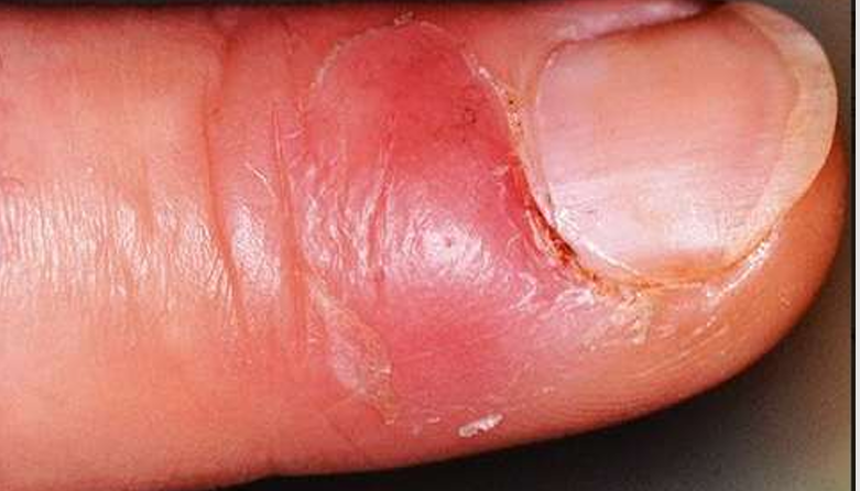 <p>Welke aandoening wordt hier afgebeeld?</p>