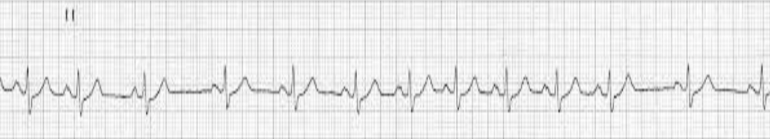 <p>benign variation in beat intervals; regular rate, irregular rhythm </p>