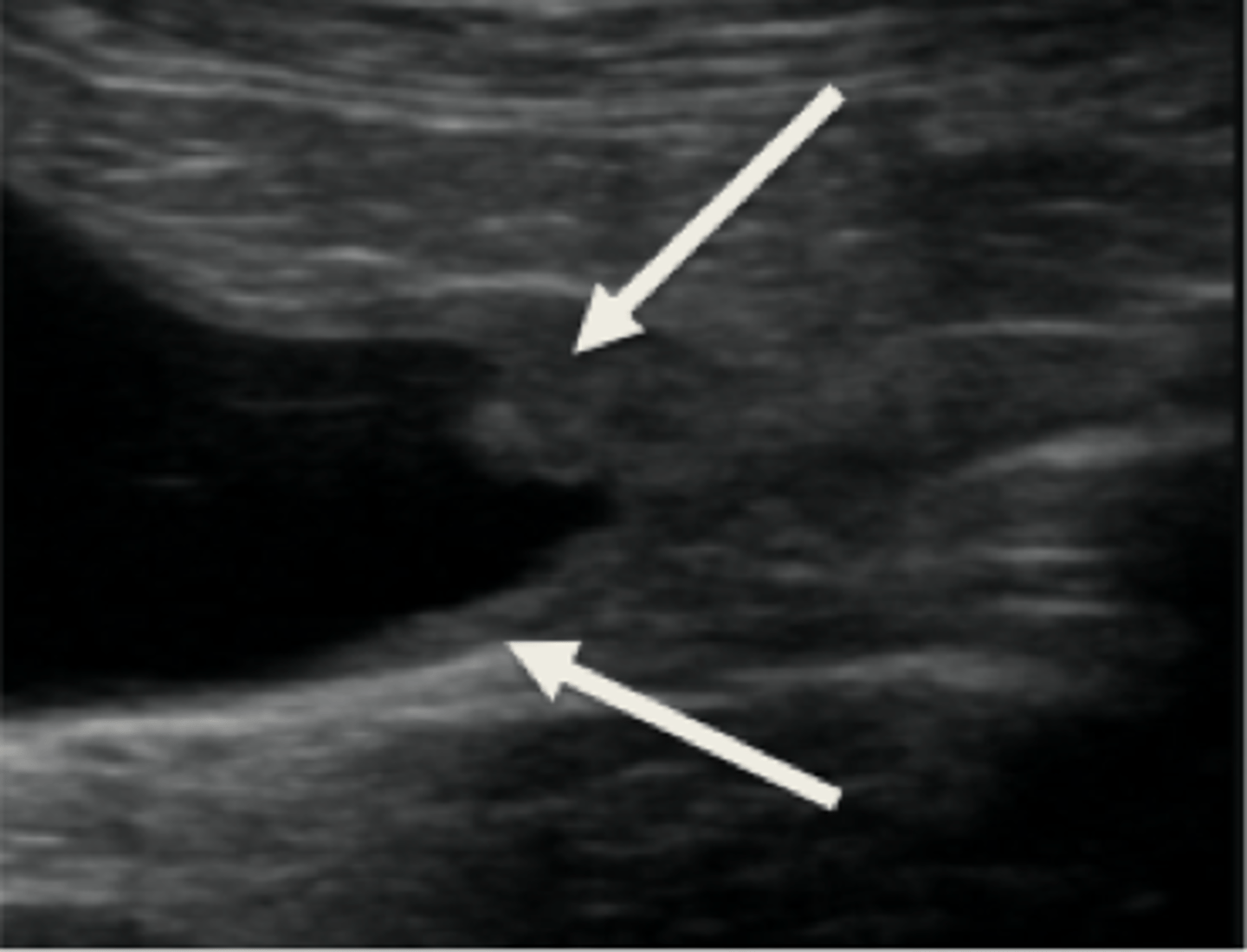 <p>Heterogenous mass</p><p>Often located at trigone/prostate/urethra in dogs</p><p>May be at trigone or other bladder regions in cats</p><p>Important to check medial iliac lymph nodes</p><p>Check ventral aspect of lumbar vertebra on radiograph for metastasis to bone</p><p>transitional cell carcinoma is most common</p>