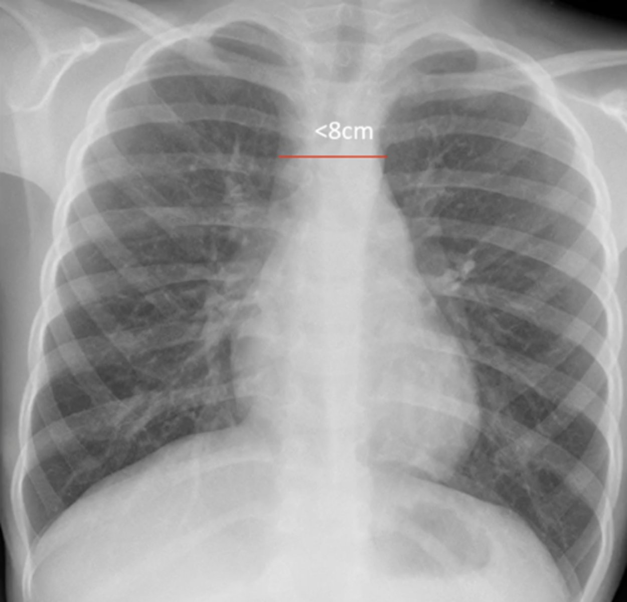 <p>(evaluating AP CXR) mediastinum size</p>