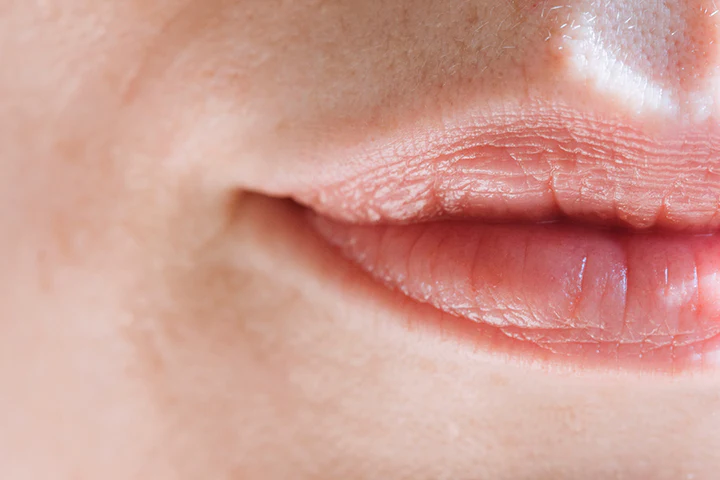 <p>Labial sulci</p>