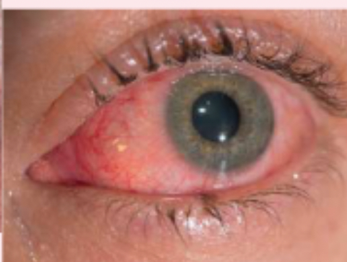 <p>generalized inflammation of the conjunctiva </p>
