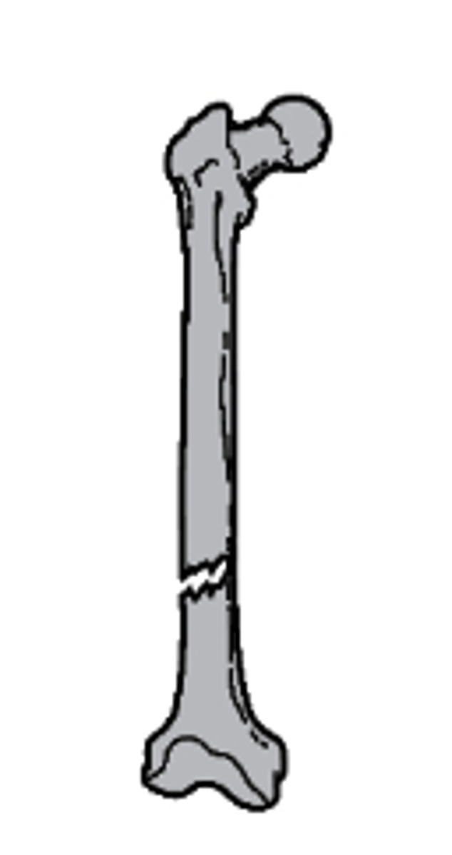<p>what type of alignment is seen with this fracture?</p><p>a. nondisplaced</p><p>b. medial displacement</p><p>c. lateral displacement</p><p>d. distracted</p>
