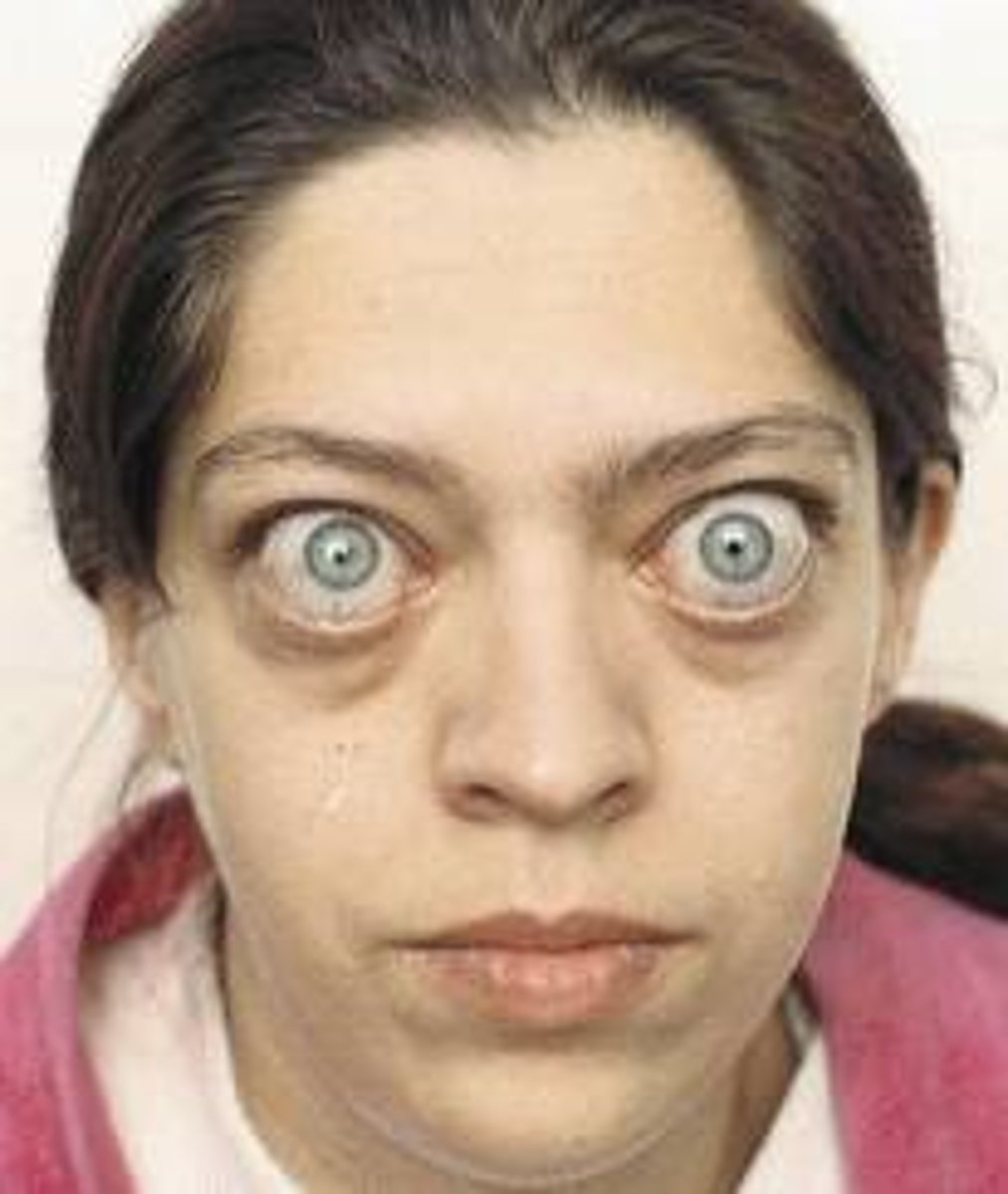<p>1. Exophthalmos (bulging eyes)<br>2. Lid lag stare<br>3. Redness<br>4. Conjunctivits<br>5. Pre-orbital oedema<br>6. Bilateral<br>7. Extra-ocular muscle swelling</p>