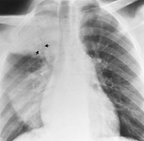 <p>PT is 43 yr old male presenting with productive cough and fever/chills<br><br>What pathology is present?</p>