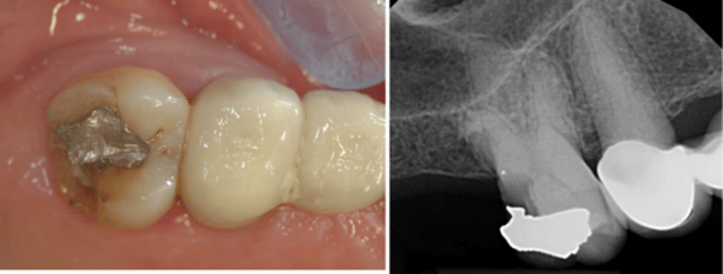 <p>What are some things to consider when deciding the treatment for this tooth?</p>