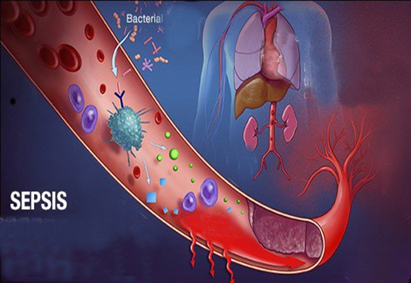<p>nhiễm trùng huyết <mark data-color="#8ce3f6" style="background-color: #8ce3f6; color: inherit">(health/cosmetic surgery)</mark> </p>