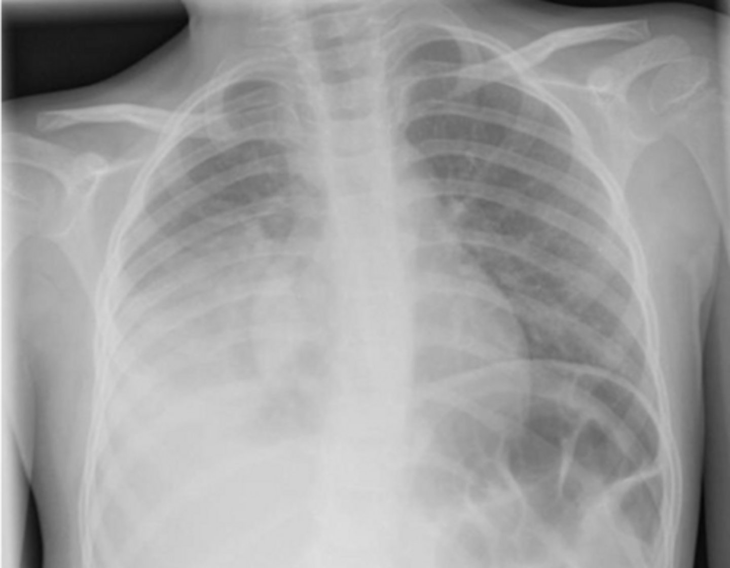<p>What is this pattern of lung disease?</p>