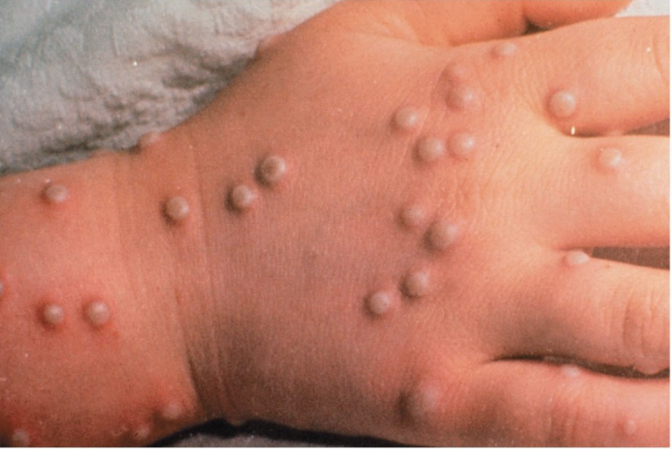<p>what disease does this vesicular/pustular rash depict?</p>