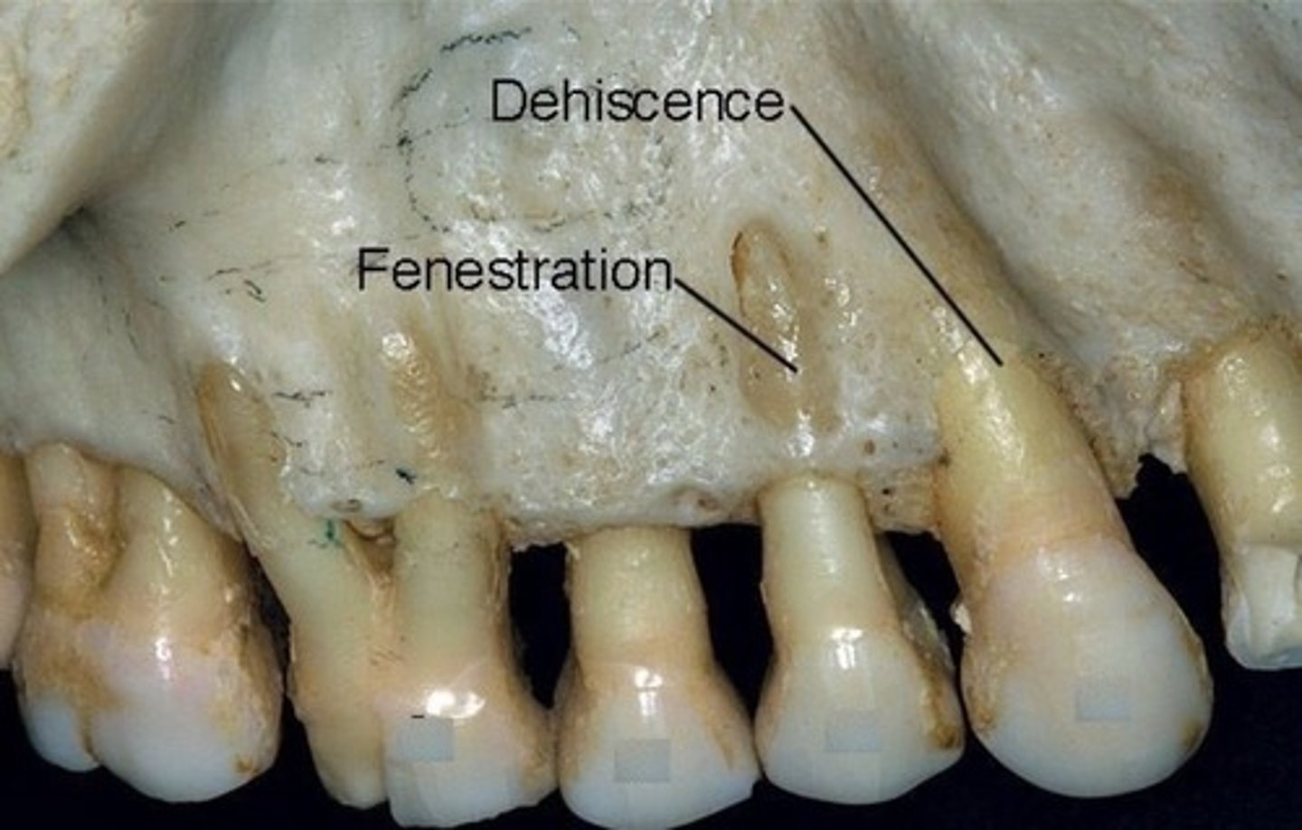 <p>window in bone</p><p>usually buccal aspect</p><p>related to recession as the gingivae shinks to where the bone is gone</p>