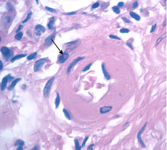 A 61-year-old man has reported increasing fatigue over the past year. Laboratory studies show a serum creatinine level of 4.7 mg/dL and a urea nitrogen level of 44 mg/dL. An abdominal ultrasound scan shows that his kidneys are symmetrically smaller than normal. The representative high-magnification microscopic appearance of the kidneys is shown in the figure. These findings are most likely to indicate which of the following underlying conditions?