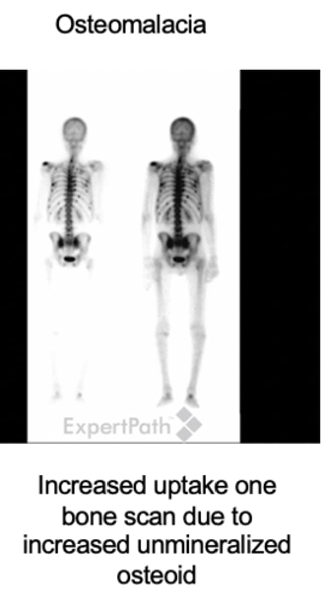 <p>bone matrix</p>