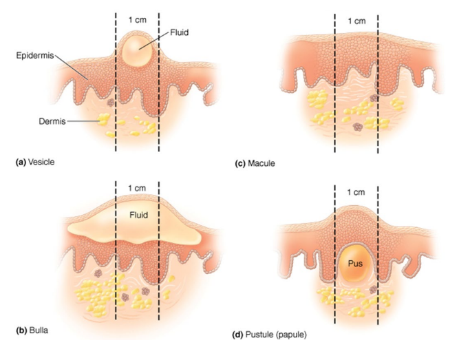 <p>T/F: Skin lesions are indicative of an infection of the skin. </p>