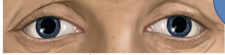 <p>Dilated and Fixed Pupils</p>