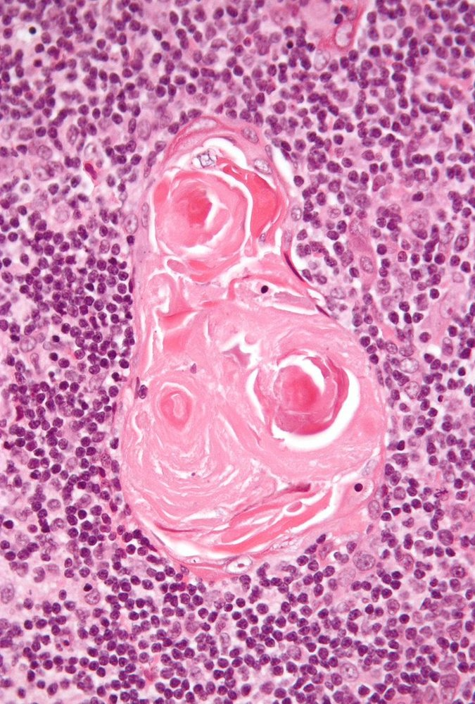 <p>A. Hassall's corpuscles</p>
