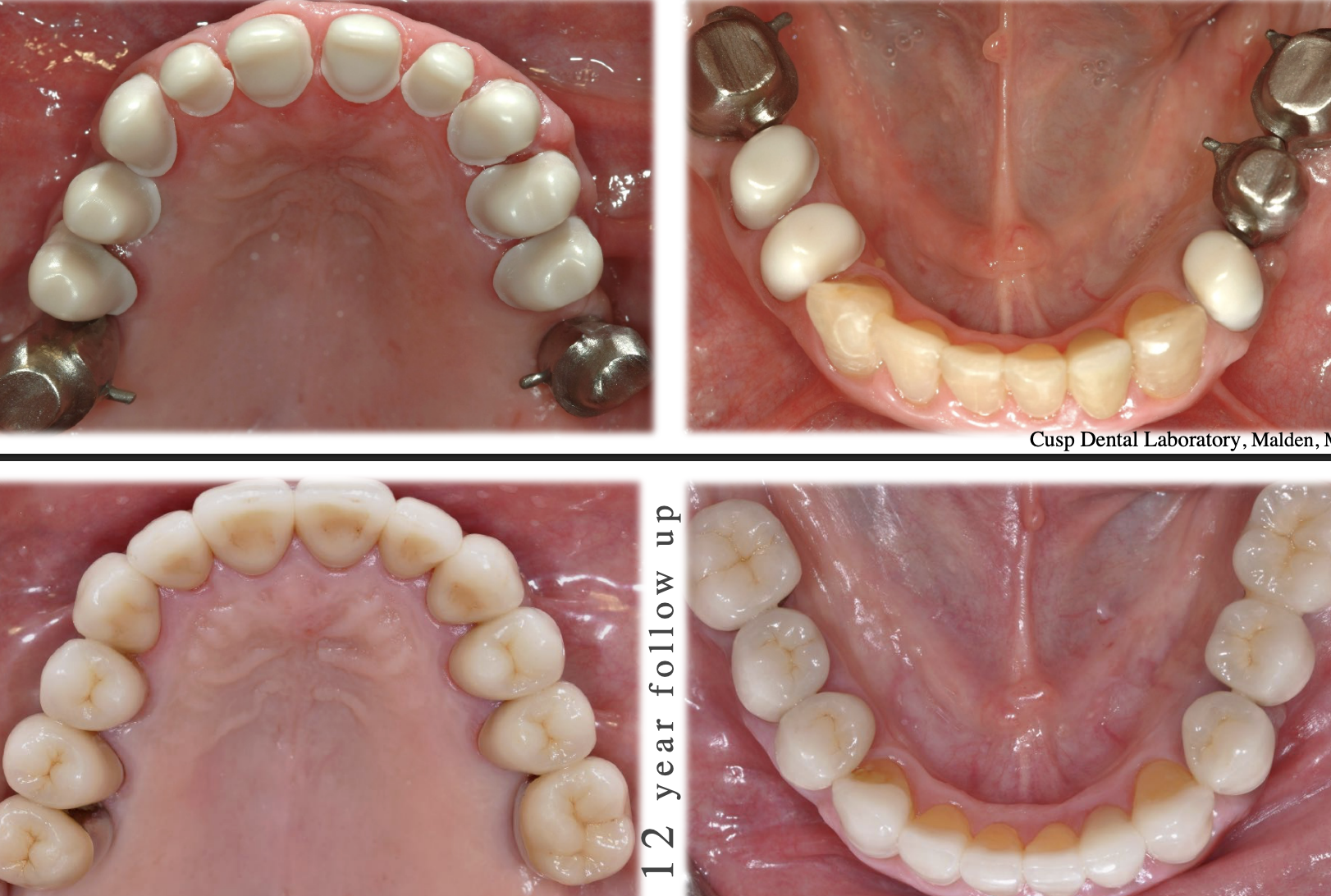 <p>high strength core w porcelain- photo shows coping w zirconia and feldspathic layered ontop </p>