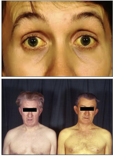 <p>What is Jaundice?</p>