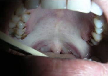 <p>-premalignant condition seen in 1-2% of areca nut and betel quid users- India, southeast Asia, Taiwan, NYC</p><p>-mucosa may appear white due to underlying fibrosis</p><p>-sometimes changes “better felt than seen”- “piano wire” feel</p><p>-patients report burning and increasing trismus</p><p>-progressive scarring/fibrosis limits mouth opening</p><p>-dysplasia may develop in long-standing lesions (7-13% of pts develop SCC)</p>