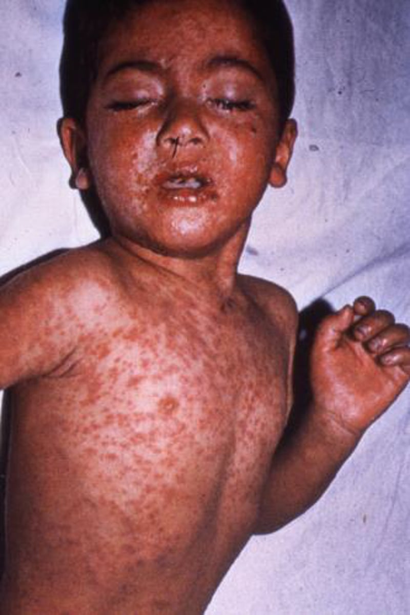 <p>Very contagious virus, report cases to CDC, Maculopapular rash on head that spreads to whole body</p>