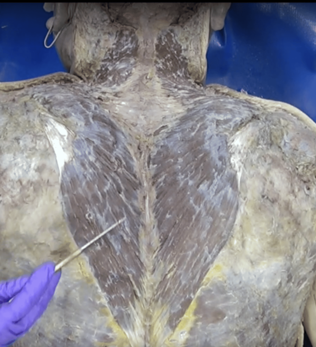 <p>Function: Extends head and neck, Insertion: Scapula, Origin: Skull and upper vertebrae</p>