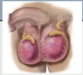 <p><strong>Orchitis</strong></p><p>-____________ of one or both testicles, usually caused by bacterial infection (___) or viral infection (_____)</p><p>-Moderate pain of ______ onset, swollen testes, fever</p><p>-Inspection → enlarged, erythematous ________. Does ___ transilluminate </p><p>-Palpation → swollen, congested, tense, and _____. Difficulty distinguishing ______ from epididymis</p>