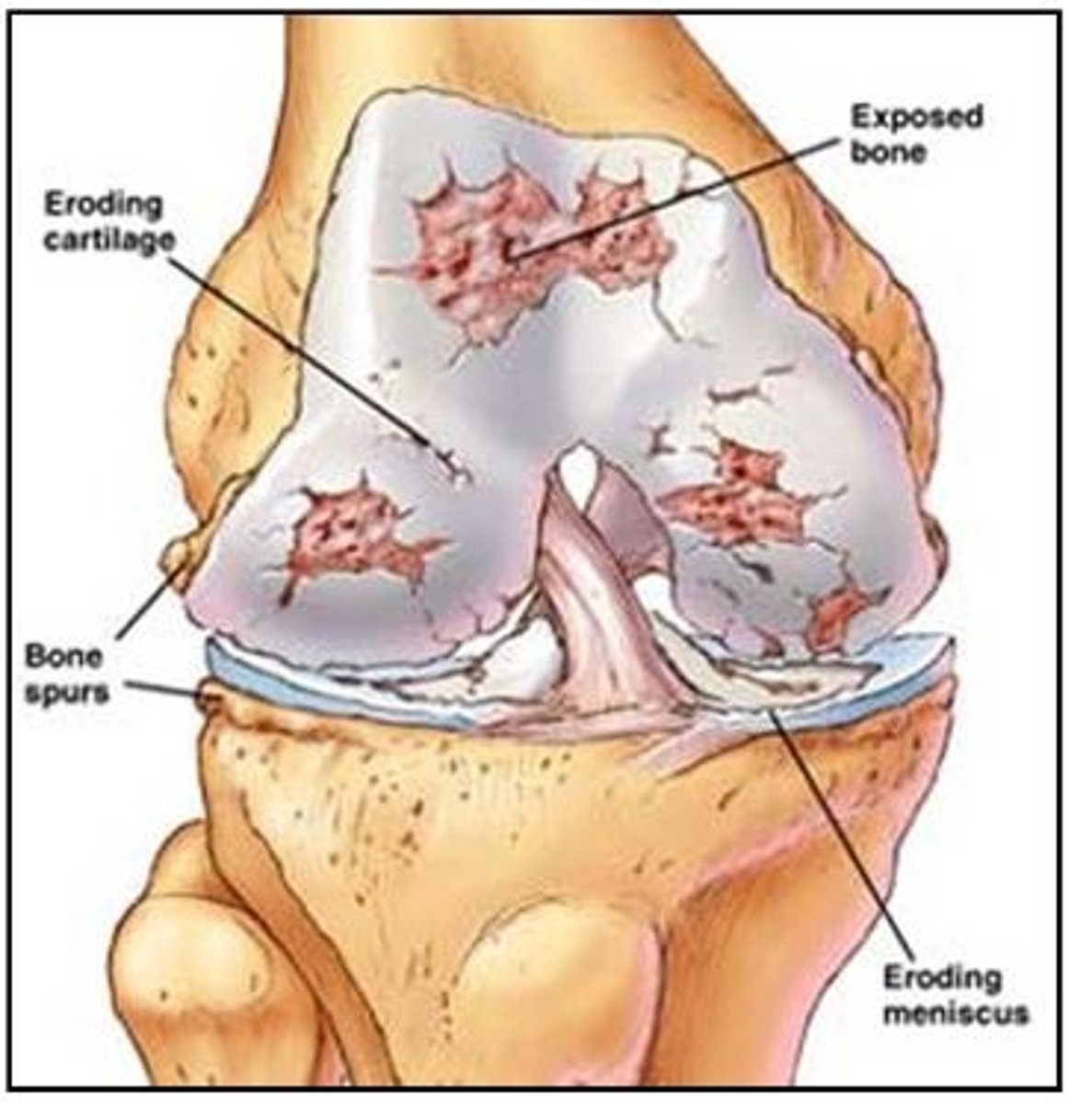 <p>Heberden's + Burchards nodes, Joint Pain</p>