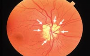 <p>What are the signs of optic nerve head drusen?</p>