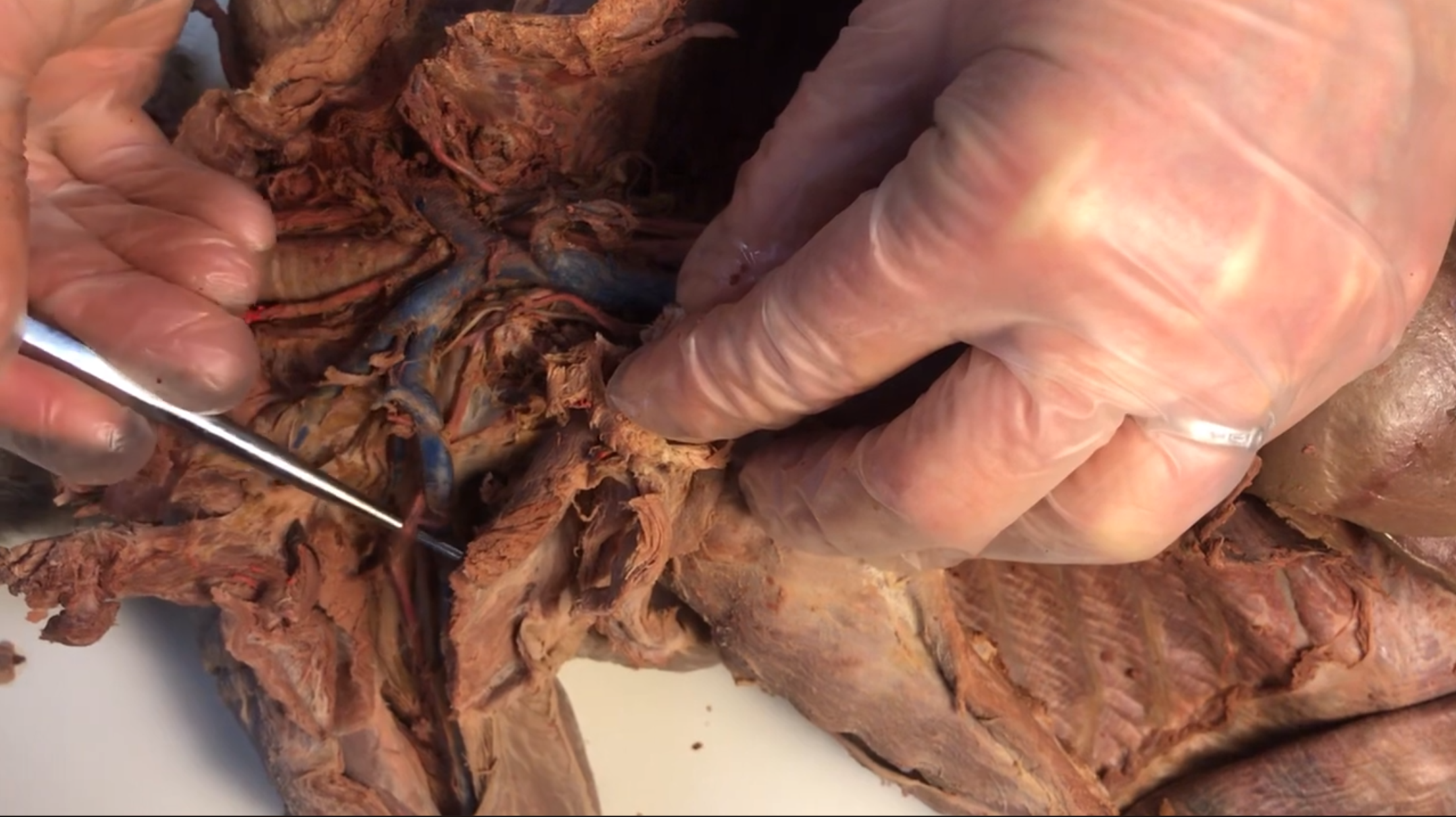 <p>What artery is this</p>