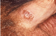 <ul><li><p>primary lesion of syphilis</p></li><li><p>painless</p></li><li><p>well-delineated</p></li></ul>