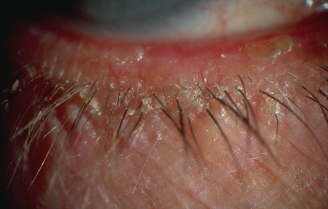 <p>seborrheic (<strong>gland of Zeiss</strong>): associated with seborrheic dermatitis - dandruff</p><p>→ disease of <strong>sebaceous gland</strong></p><p></p><ul><li><p><u>greasy deposits</u> at base of lashes</p></li></ul><p></p><ul><li><p>associated with <strong>dermatitis rosacea</strong></p></li></ul><p></p>