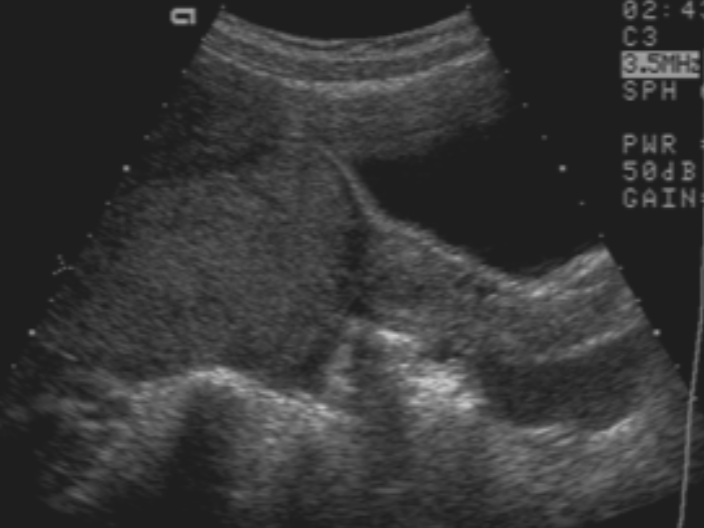 <ul><li><p><span style="color: #ff0000">Most common pediatric malignant ovarian mass</span></p></li><li><p>counterpart of testicular seminoma</p></li><li><p>low-grade malignancy</p><ul><li><p>potentially curable</p></li></ul></li><li><p>solid mass that may contain septa and calcifications</p></li></ul><p></p>