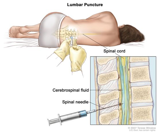 <ul><li><p>A <strong>spinal tap</strong> can be used to extract CSF by inserting a needle below the the spinal cord termination</p></li><li><p>The CSF can be used to help diagnose serious infections, such as meningitis.</p></li></ul><p></p>