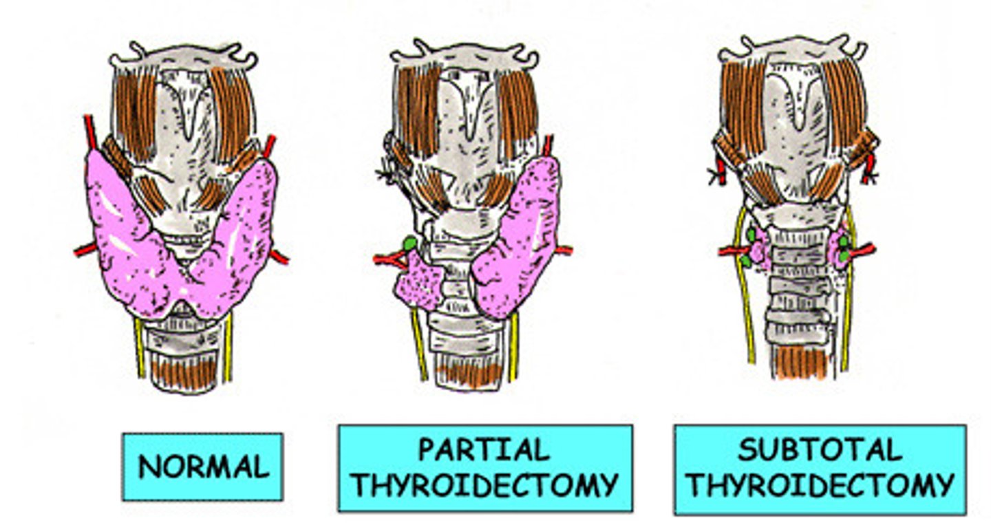 <p>- partial or total thyroidectomy</p><p>&gt; total only done if large nodules or thyroid cancer</p><p>&gt; may cause hypothyroidism which requires lifelong tx of levothyroxine</p><p>- removes part of gland to decrease thyroid hormone synthesis and secretion</p><p>&gt; only done if drug tx does not work</p>
