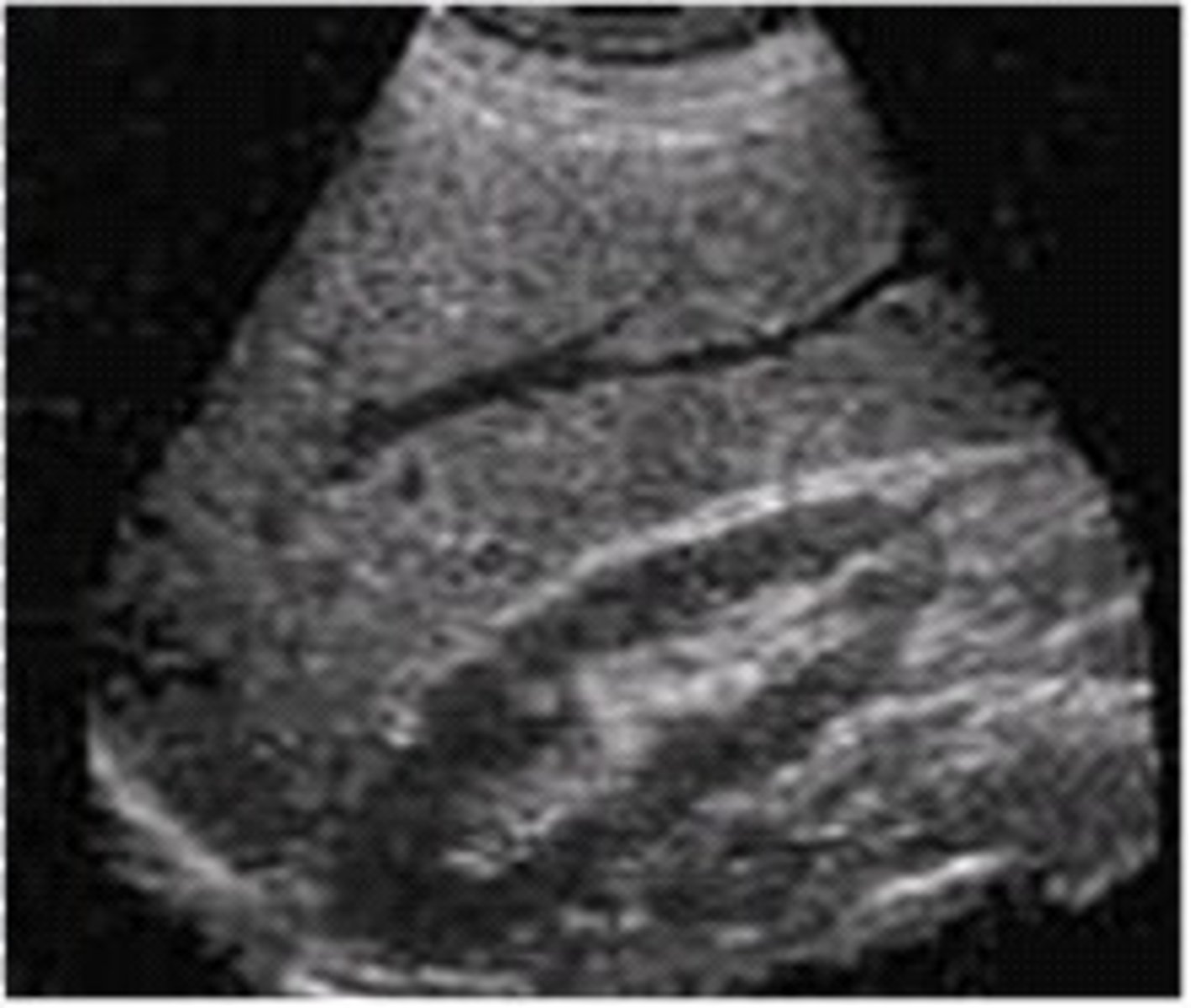 <p>Result of scattering due to the rough surface characteristics, partial constructive and destructive interference occurs resulting in a "speckle" appearance of the tissue</p>