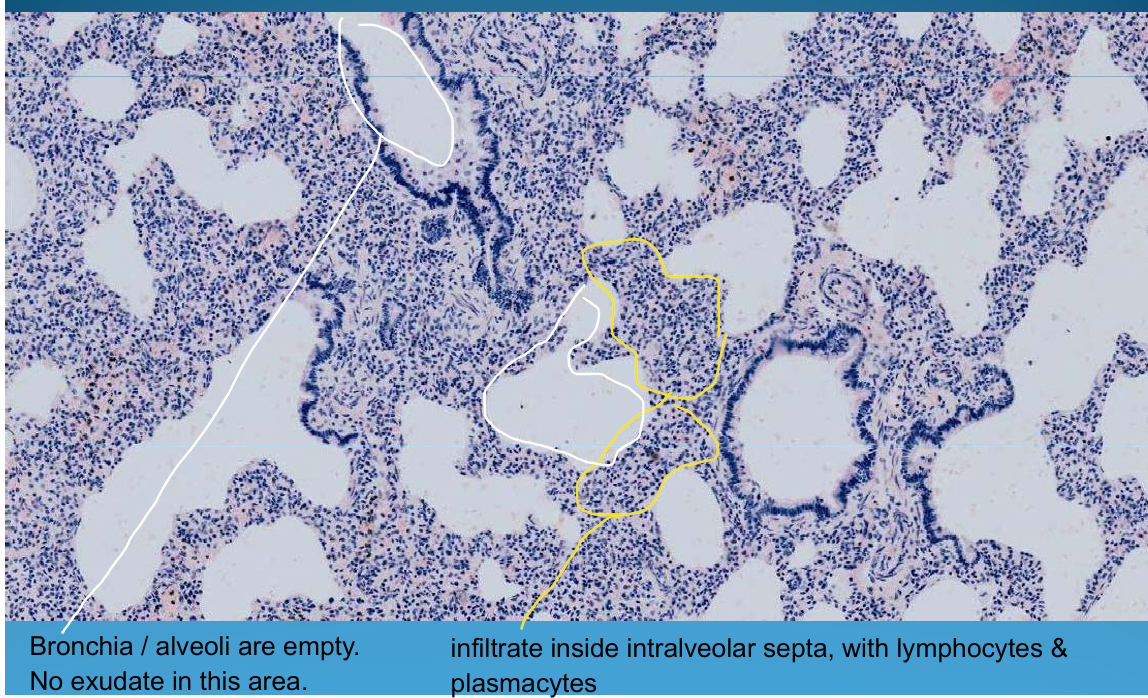 <p>LUNG:</p><p>Intersititial pneumonia - thick septum, lymphocyte and plasma cell infiltrate inside interalveolar septa, smooth alveoli</p>
