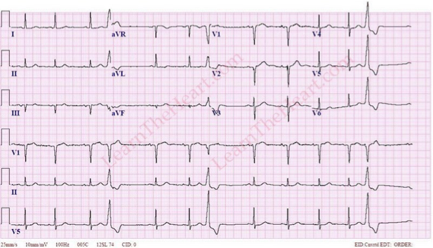 <p>What does this refer “Wide and bizarre QRS complexes”</p>