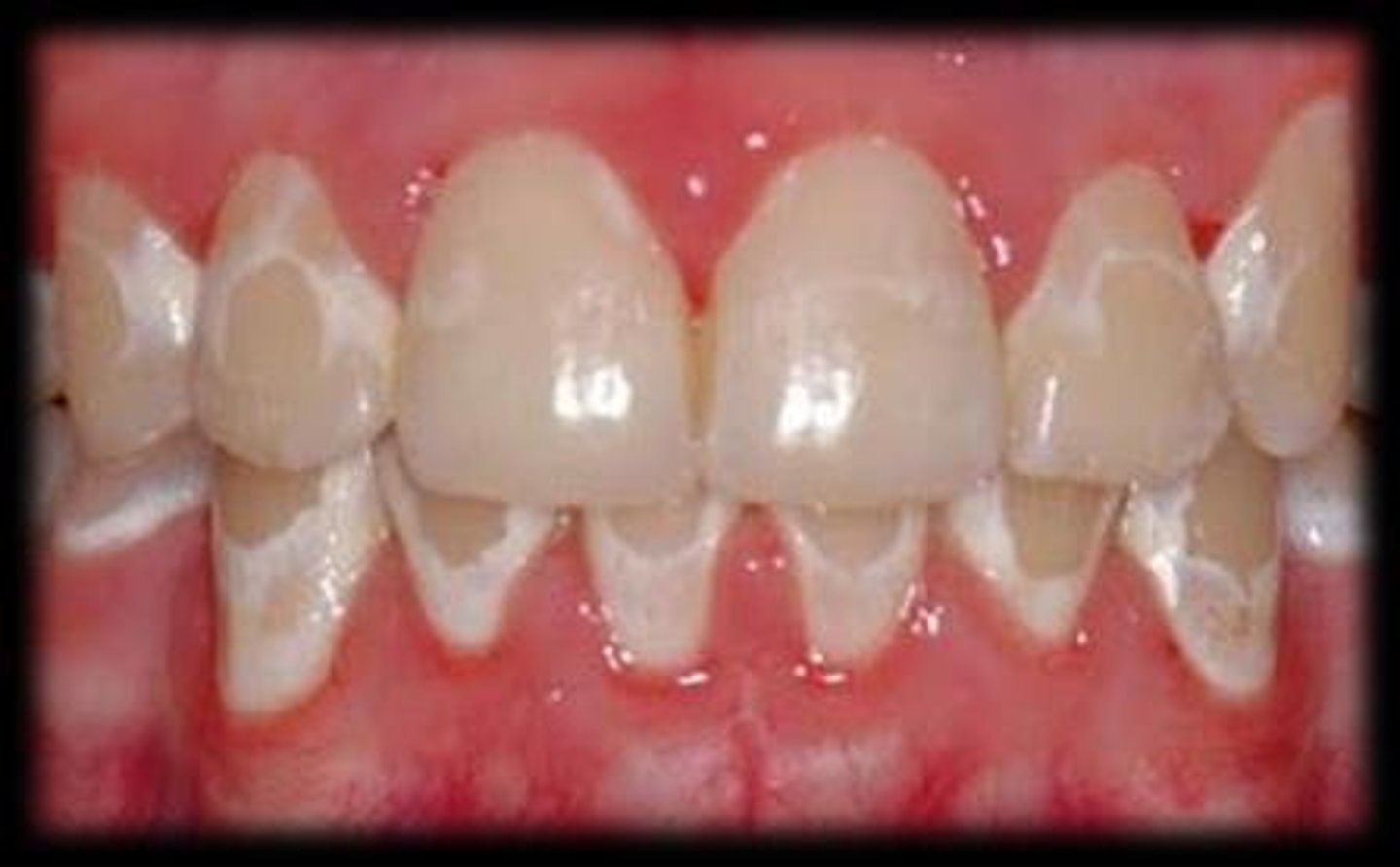 <p>A form of enamel hypocalcification caused by excessive fluoride, leading to discoloration ranging from white flecks to brownish spots.</p>