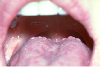 <p>which lingual papillae is NOT present on the DORSAL surface of the tongue</p>