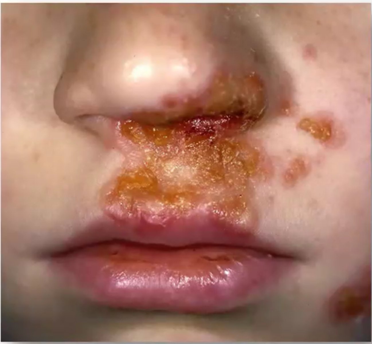 <p>Which kind of impetigo is characterized by small, fluid-filled vesicles that discharge to form dry, honey-crusted lesions?</p>