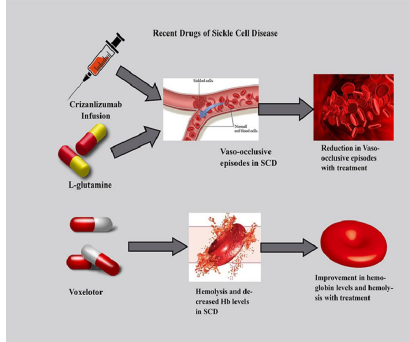 <p>Variable from patient to patient</p><ul><li><p>Mainly systemic: organ and tissue ischaemia.</p></li><li><p>Episodes of crises:</p><ul><li><p>Vaso-occlusive (VOC- sickle cells block blood vessels)</p></li><li><p>Visceral sequestration (VOC in spleen, leads to hypervolemic shock)</p></li><li><p>Aplastic (bone marrow stops making RBCs)</p></li><li><p>Haemolytic</p></li></ul></li><li><p>Chronic haemolytic anaemia</p></li></ul><p></p>