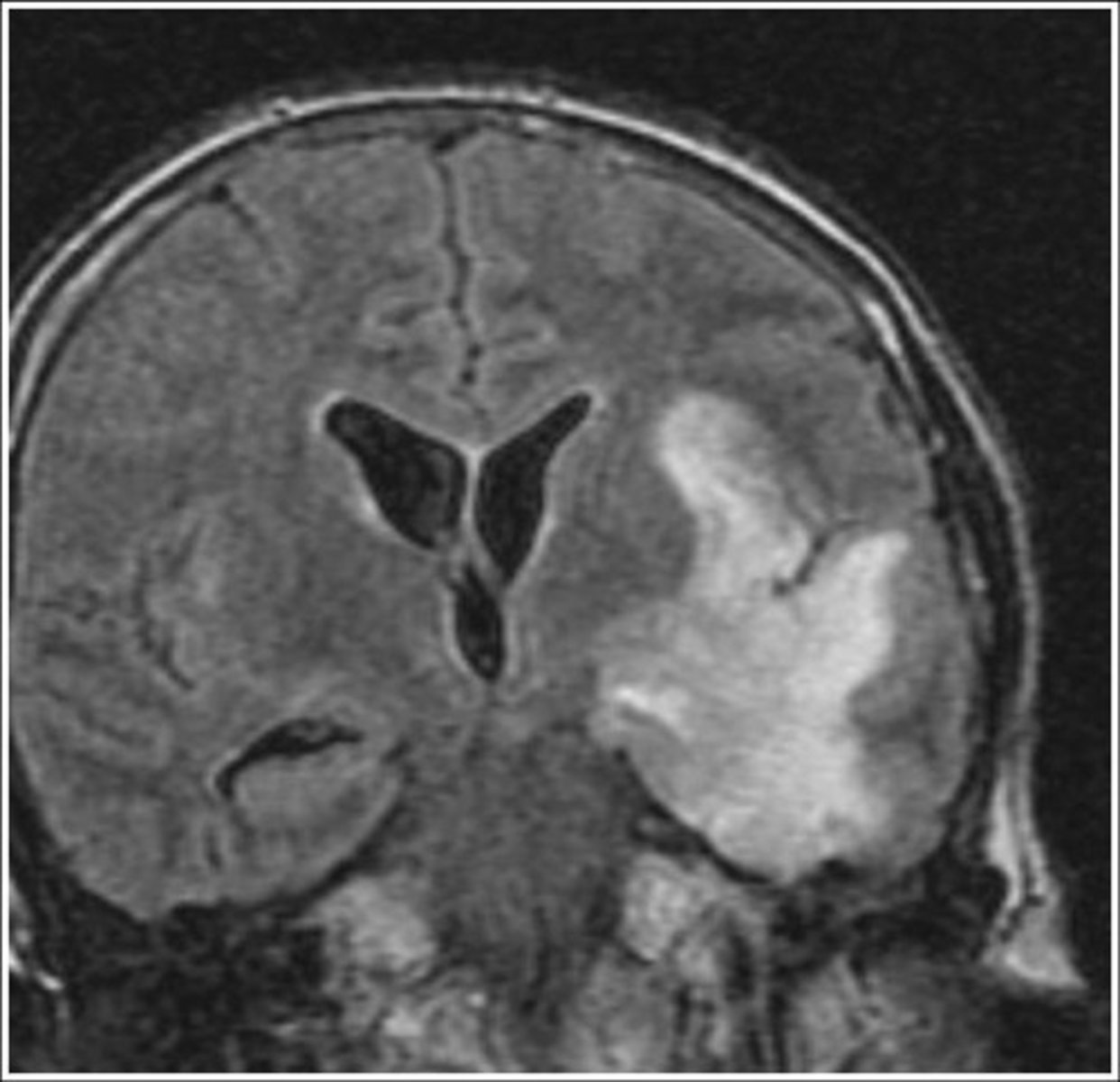 <p>inflammation of the brain</p>