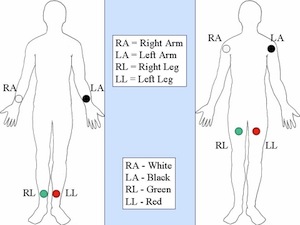 <p>RA electrode - right arm on the wrist</p><p>LA electrode - left arm on the wrist</p><p>LL electrode - left leg on the thigh/ankle (or lower left side of the abdomen)</p><p>RL electrode - right leg on the thigh/ankle (or right abdomen)</p>