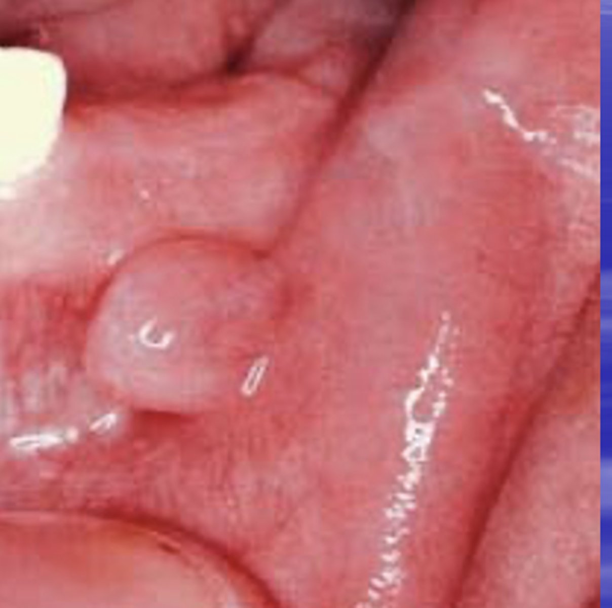 <p>benign tumor of Schwann cell origin that is a smooth surfaced, pink nodule </p>