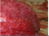 <p>Margin of the lesion</p>