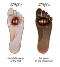 <ul><li><p>Grade 4</p><ul><li><p>wet or dry gangrene of toe or dorsum of the foot, often with plantar infection</p></li></ul></li><li><p>Grade 5</p><ul><li><p>extensive gangrene of the foot with necrotic lesions and soft tissue infections indicating higher amputation </p></li></ul></li></ul><p></p>